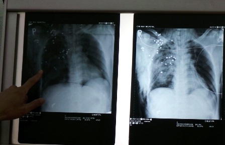 Khoảng 40 viên đạn súng tự chế đã nằm gọn trong cơ thể nạn nhân