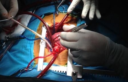 Trái tim “lỗi nhịp” nằm bên phải, bé 3 tuổi thường xuyên đau đớn - 1 Các bác sĩ phẫu thuật cứu trái tim lỗi nhịp của bé B.