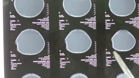 Hình ảnh X-Quang cho thấy vùng sọ của bé Tuấn Minh bị lõm