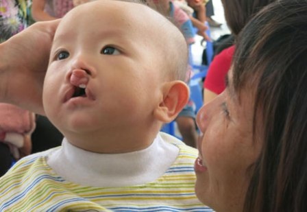 Chỉ với 5 triệu đồng và 45 phút phẫu thuật, trẻ sẽ có cuộc đời mới