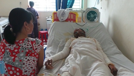 Bỏng lửa xăng là tai nạn đặc biệt nguy hiểm 