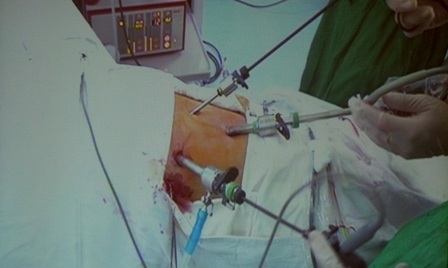 Ca nội soi thực hiện tại bệnh viện Bình Dân