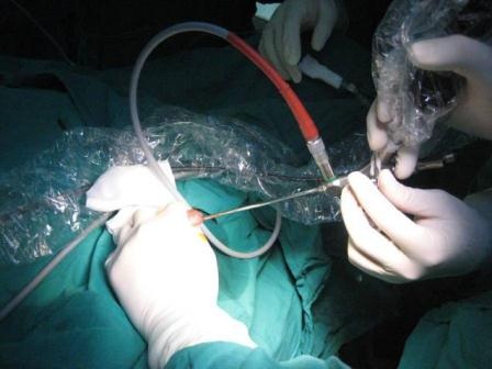 Bệnh nhi được can thiệp bằng phương pháp nội soi tán sỏi