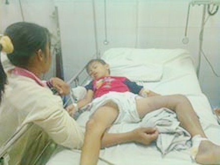Bé trai nguy kịch vì trị rắn cắn ở thầy lang - 1 Chân trái bé C. tím bầm do nhiễm độc nặng