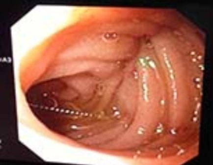 Đi chữa răng, bé 4 tuổi nuốt luôn cây kim - 1 Cây kim nằm chắn ngang tá tràng được phát hiện qua nội soi