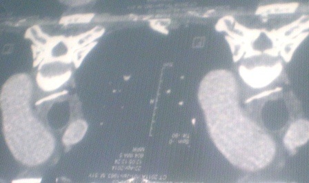 Hình ảnh cho thấy chiếc xương gà (nằm ngang) đâm thủng thực quản nạn nhân