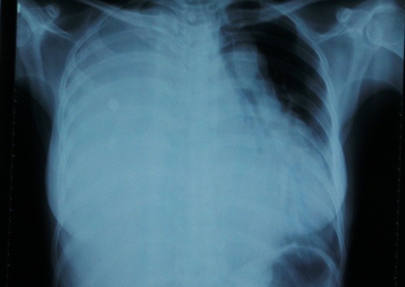 Khối u lớn chiếm trọn lồng ngực người bệnh