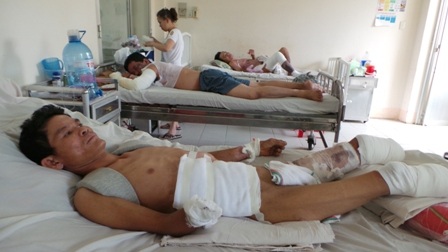 Một trường hợp bỏng điện phải cắt cụt một tay và hai chân điều trị tại Chợ Rẫy