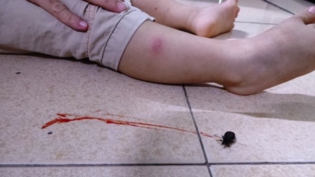 Vùng mẩn đỏ trên da cậu bé và vệt máu tươi từ con bọ