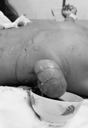 Ruột bệnh nhân bị lòi ra ngoài sau cú húc chí mạng của con trâu