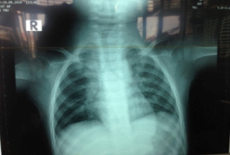 Bé 1 tuổi nguy kịch vì hạt mãng cầu gây tắc phế quản - 1 Hình ảnh X-quang cho thấy phổi phải của bệnh nhi bị xẹp do dị vật