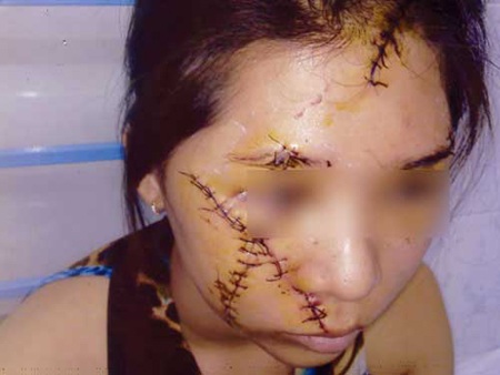 Nhóm dùng dao lam rạch nát mặt cô gái lãnh 9 năm tù