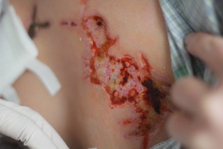 Cô gái bị xăm "quái vật" vào mặt và ngực mang thương tật 30% - 3 Cô gái bị xăm quái vật vào mặt và ngực mang thương tật 30%