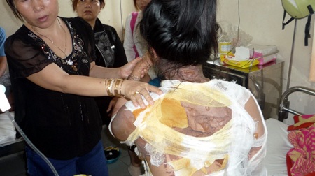 Phỏng nặng vì bị chồng tạt nồi nước sôi vào người - 1 Phỏng nặng vì bị chồng tạt nồi nước sôi vào người