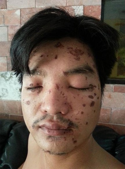 Nạn nhân Hoàng Văn Trung bị phỏng toàn thân do bị băng nhóm Nguyễn Văn Việt tạt axít