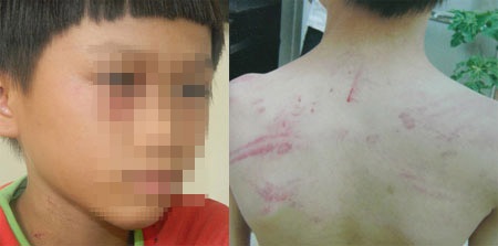 Cháu Trần Tự bị đa chấn thương phần mềm do bị đánh bằng cây (roi)