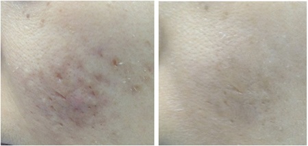 Hiệu quả ấn tượng từ chương trình “Điều trị sẹo và vết thâm với Acnes C10” - 2 Sẹo, vết thâm; lỗ chân lông to (Trước – sau 8 tuần sử dụng Acnes C10)