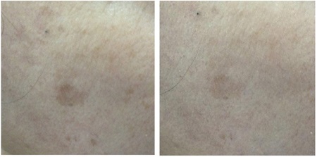 Hiệu quả ấn tượng từ chương trình “Điều trị sẹo và vết thâm với Acnes C10” - 3 Nám, tàn nhang (Trước – sau 8 tuần sử dụng Acnes C10)