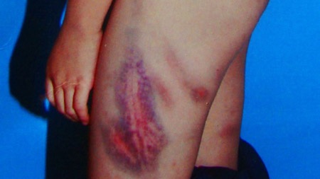 Vết thương của cháu Hùng Anh khi mới bị bà Thảo đánh