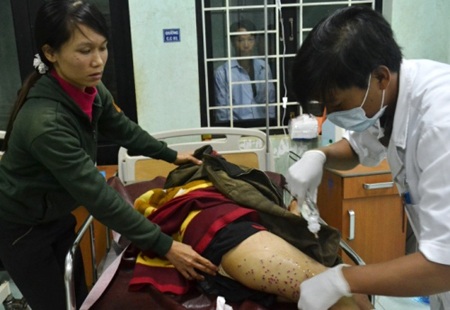 Bảo vệ dùng súng hoa cải bắn người dân bị thương nặng - 1 Nhiều đạn chì găm sâu vào cơ thể nạn nhân