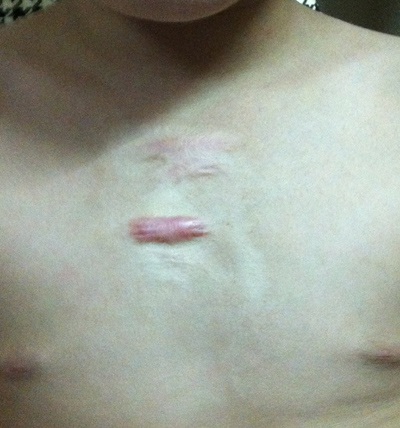 Một trường hợp cháu bé bị bỏng bình nóng lạnh tại bệnh viện Xanh Pôn