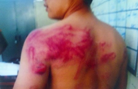 Dân tố bị công an đánh bầm người - 1 Dân tố bị công an đánh bầm người