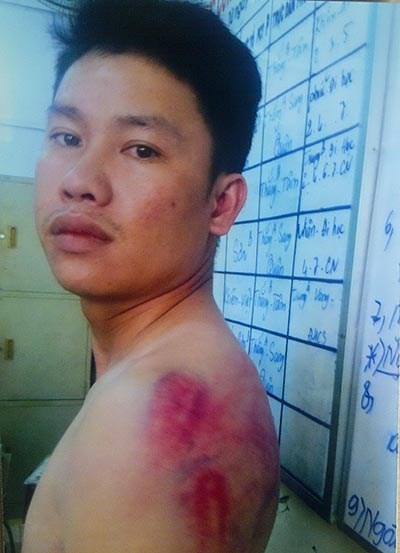 Dân tố bị công an đánh bầm người - 2 Dân tố bị công an đánh bầm người