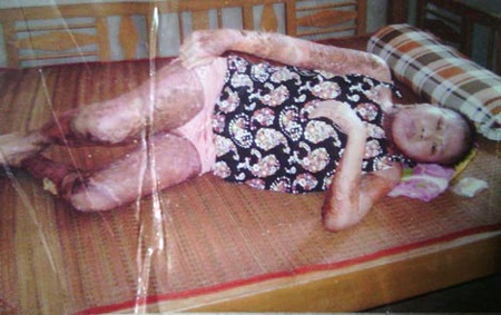 Ngày mới ra viện, Nga nằm co quắp một chỗ.