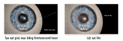 Femtosecond Laser: Chọn lựa mới để phục hồi thị lực - 2