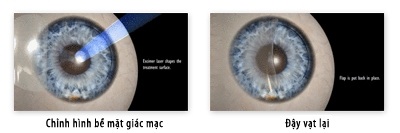 Femtosecond Laser: Chọn lựa mới để phục hồi thị lực - 3