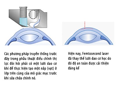 Femtosecond Laser: Chọn lựa mới để phục hồi thị lực - 1