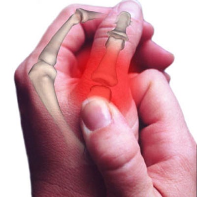Biểu hiện của bệnh viêm khớp xương mãn tính - 1 Biểu hiện của bệnh viêm khớp xương mãn tính - 1