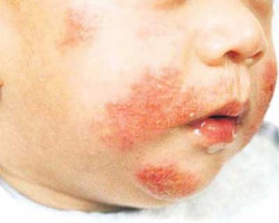 Có nên xem thường bệnh dị ứng? - 1 Có nên xem thường bệnh dị ứng? - 1