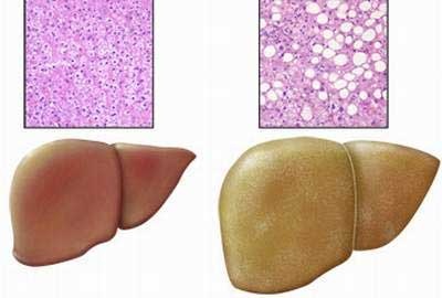 Không uống rượu bia, vẫn bị gan nhiễm mỡ - 1