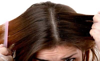 4 lưu ý khi trị gàu tại nhà - 1 4 lưu ý khi trị gàu tại nhà - 1