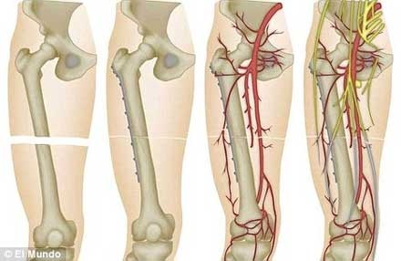 Trường hợp đầu tiên trên thế giới được ghép 2 chân - 1 Trường hợp đầu tiên trên thế giới được ghép 2 chân - 1
