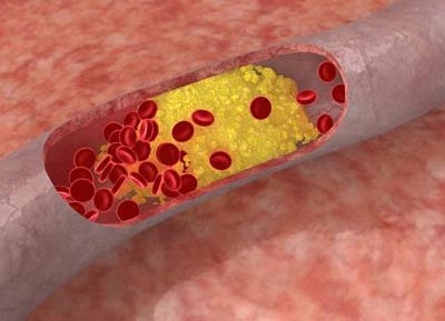 Phát hiện ra cholesterol “siêu xấu” - 1