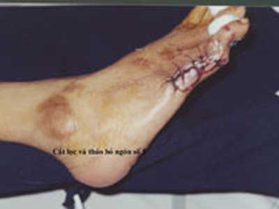 Tại sao bệnh nhân đái tháo đường dễ bị nhiễm trùng? - 1