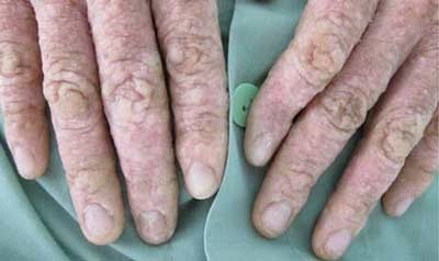 Nhiễm độc do chữa “tiệt căn vẩy nến” - 1