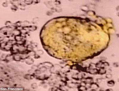 Trường hợp đầu tiên được chữa khỏi AIDS - 2