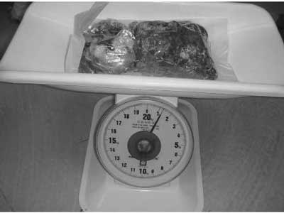 Bóc tách thành công khối u nặng 1,3kg trên mặt thiếu nữ - 2 Bóc tách thành công khối u nặng 1,3kg trên mặt thiếu nữ - 2