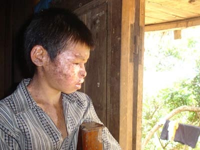 Hòa Bình: 8 trường hợp tàn tạ vì… ngứa - 2 Hòa Bình: 8 trường hợp tàn tạ vì… ngứa - 2