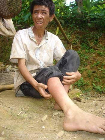 Hòa Bình: 8 trường hợp tàn tạ vì… ngứa - 1 Hòa Bình: 8 trường hợp tàn tạ vì… ngứa - 1
