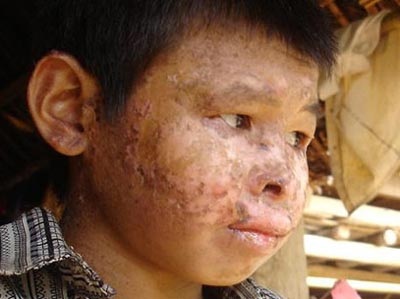 Khô da sắc tố - Thủ phạm gây bệnh ngứa “điên” ở Hòa Bình - 1 Khô da sắc tố - Thủ phạm gây bệnh ngứa “điên” ở Hòa Bình - 1