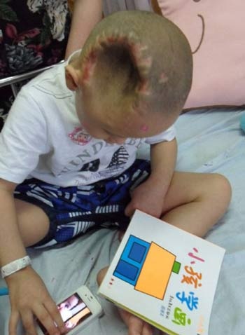 Bé trai 4 tuổi bị đánh lõm gần nửa đầu - 1