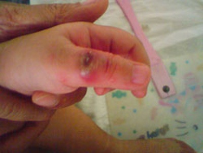 Bé 18 tháng bị loét tay vì "nghiện" mút tay - 1 Bé 18 tháng bị loét tay vì "nghiện" mút tay - 1