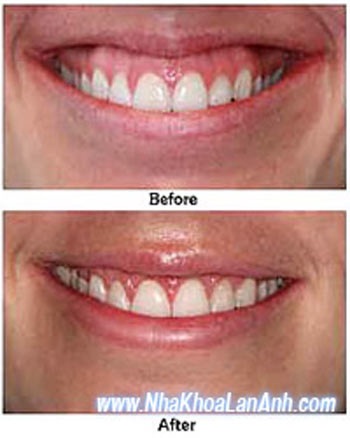 Khổ vì cười hở… lợi - 1