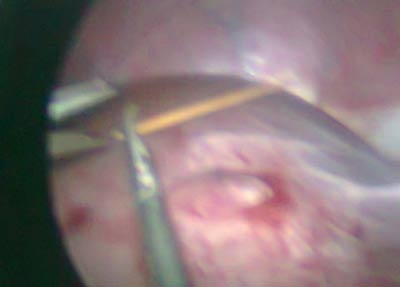 Cấp cứu vì nuốt... tăm xỉa răng - 1 Cấp cứu vì nuốt... tăm xỉa răng - 1