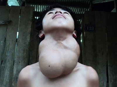 Một người mang bướu cổ nặng gần 3kg - 1