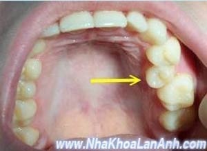 Chỉnh nha cho trẻ em và thiếu niên - 2 Chỉnh nha cho trẻ em và thiếu niên - 2